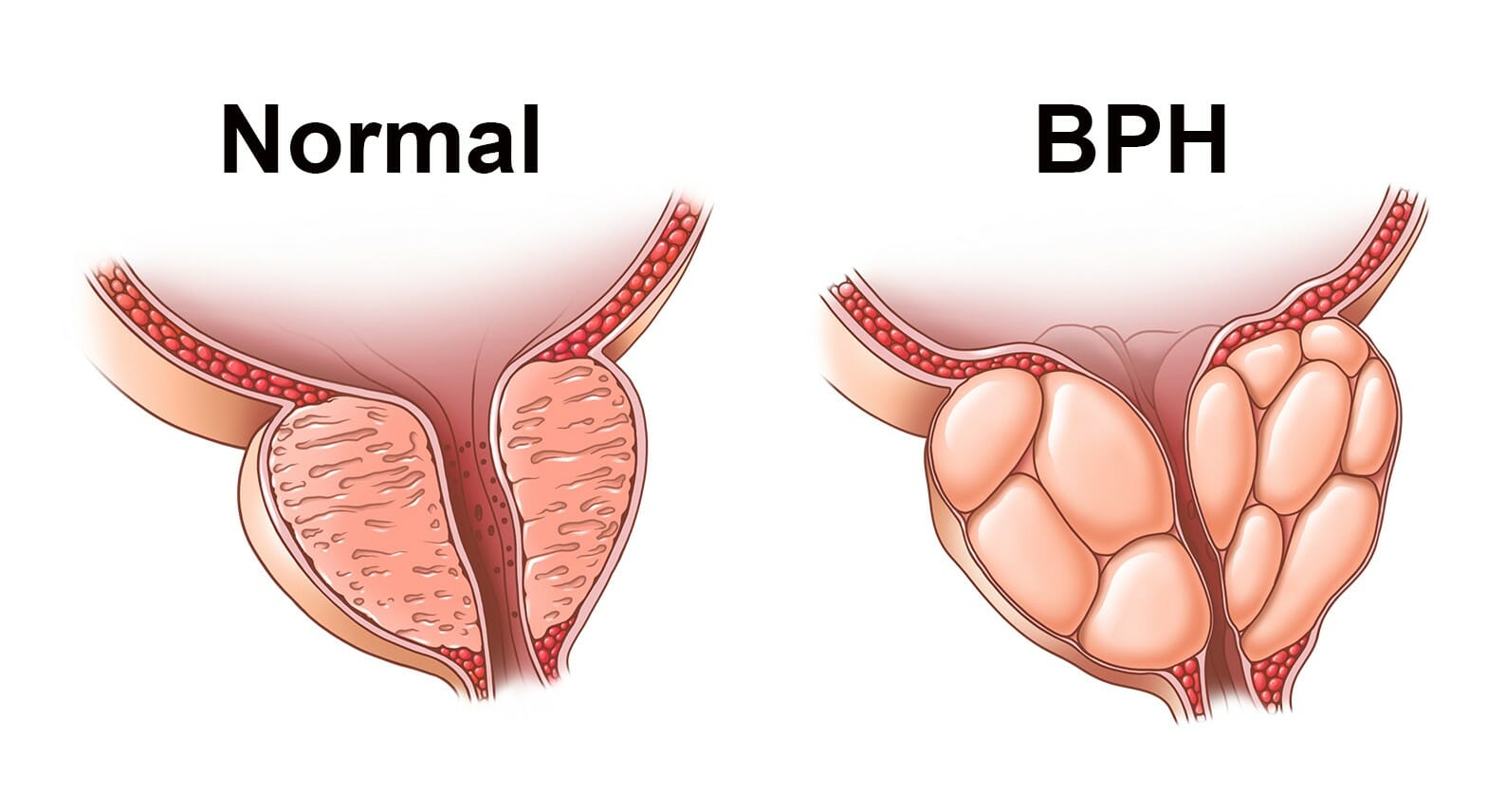 When the Urethra shrinks, Urine cannot pass through causing pain.