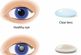 cataract chart